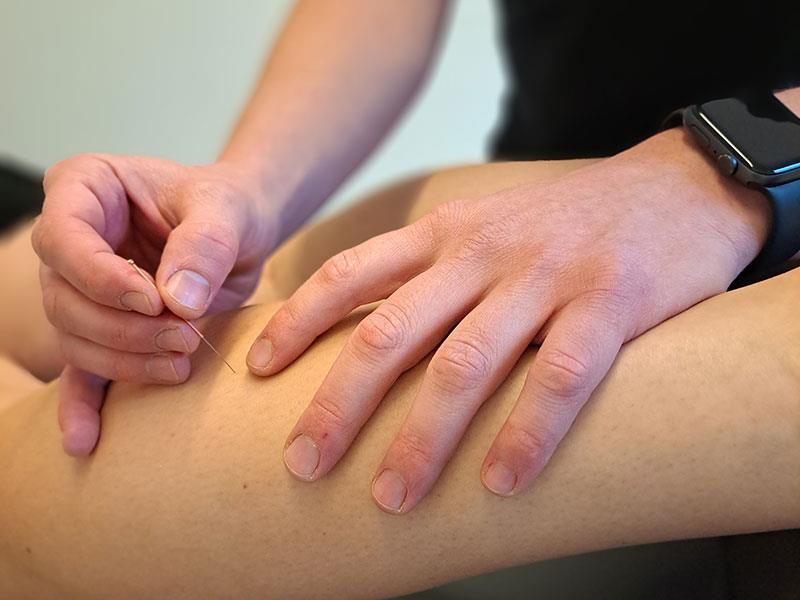 Dry Needling - toRecover, kinesitherapiepraktijk Essen